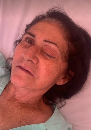 Infecção em mutirão de catarata no RN ganha destaque nacional após deixar idosa cega e infectar dezenas de pessoas