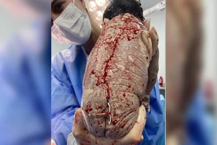 Bebê nasce com DIU colado ao corpo e caso viraliza nas redes