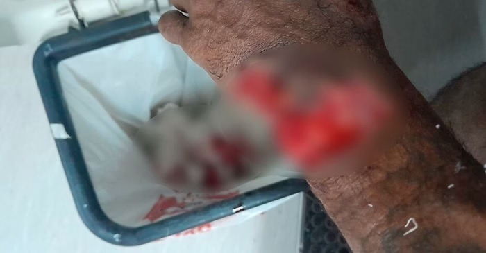 Homem quase perde a mão após ataque com facão por crise de ciúmes do ex da amiga