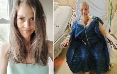 Mulher tem mais da metade do corpo queimado após cigarro eletrônico explodir