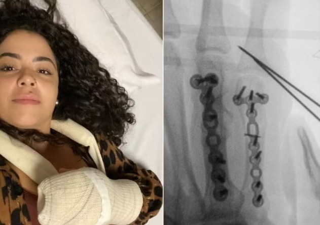 Mãe faz alerta após se ferir gravemente em brincadeira na escola: "Esmagou a minha mão"