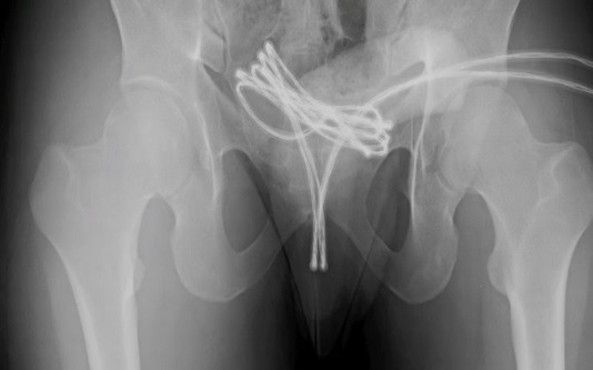 Homem precisa de cirurgia para retirar cabo USB do pênis; veja