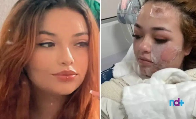 Após 6 dias na UTI, morre jovem que teve queimaduras graves após usar banheira de motel no PR