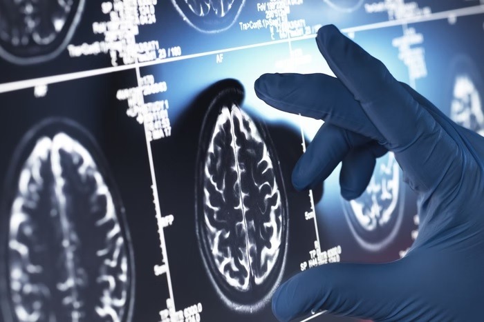 Paciente mais jovem com Alzheimer teve sinais aos 17 anos. Saiba quais