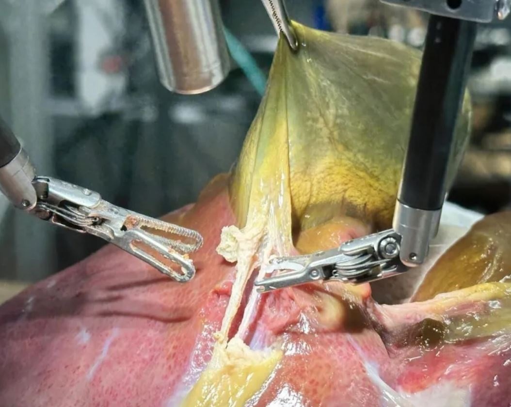 Pela 1ª vez na história, robô faz cirurgia guiado por IA sem ajuda humana
