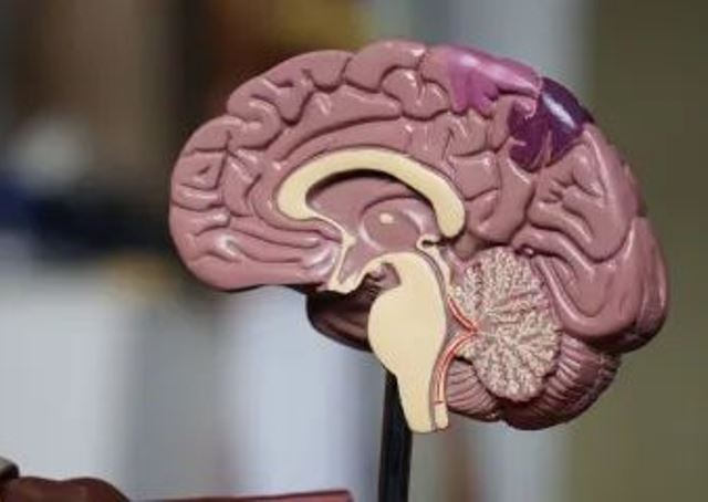 Colesterol e açúcar no sangue aos 30 anos aumentam risco de Alzheimer, diz estudo